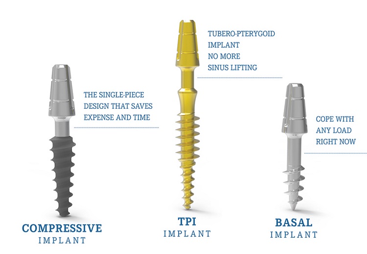 Иновативната система за зъбни импланти с незабавно натоварване Basalfix