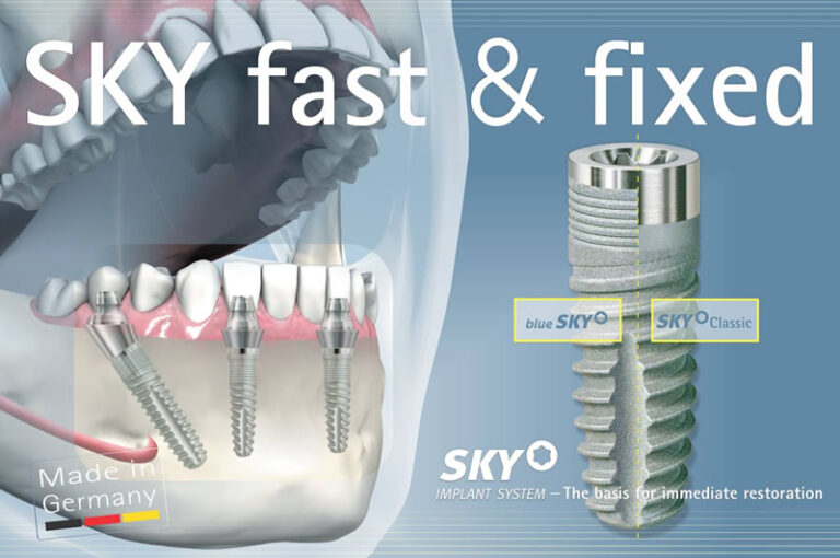 Иновативният материал за протетични решения SKY Elegance и SKY Fast&Fixed – импланти и протетични елементи